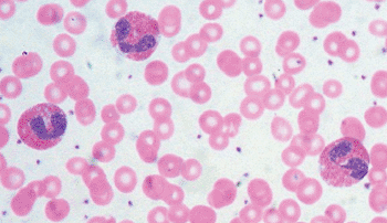 Imagen: Tres eosinófilos en un frotis de sangre periférica de un paciente con eosinofilia (Fotografía de Ed Uthman, MD).